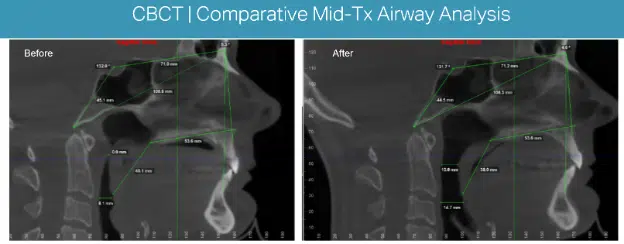 CBCT comparative mid tx airway analysis